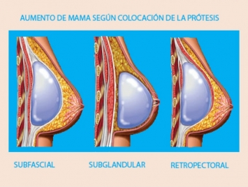 Aumento-de-pecho-lugar-de-colocacion-de-las-protesis-ventajas-e-inconvenientes