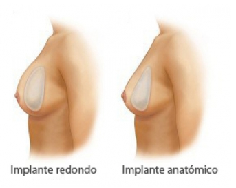 aumento-de-pecho-santander-implantes-redondos-o-anatomicos