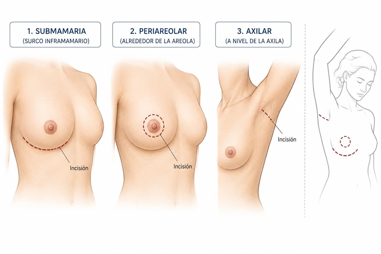 lugar de incisión en el aumento de pecho Clínica Dr. Sanz
