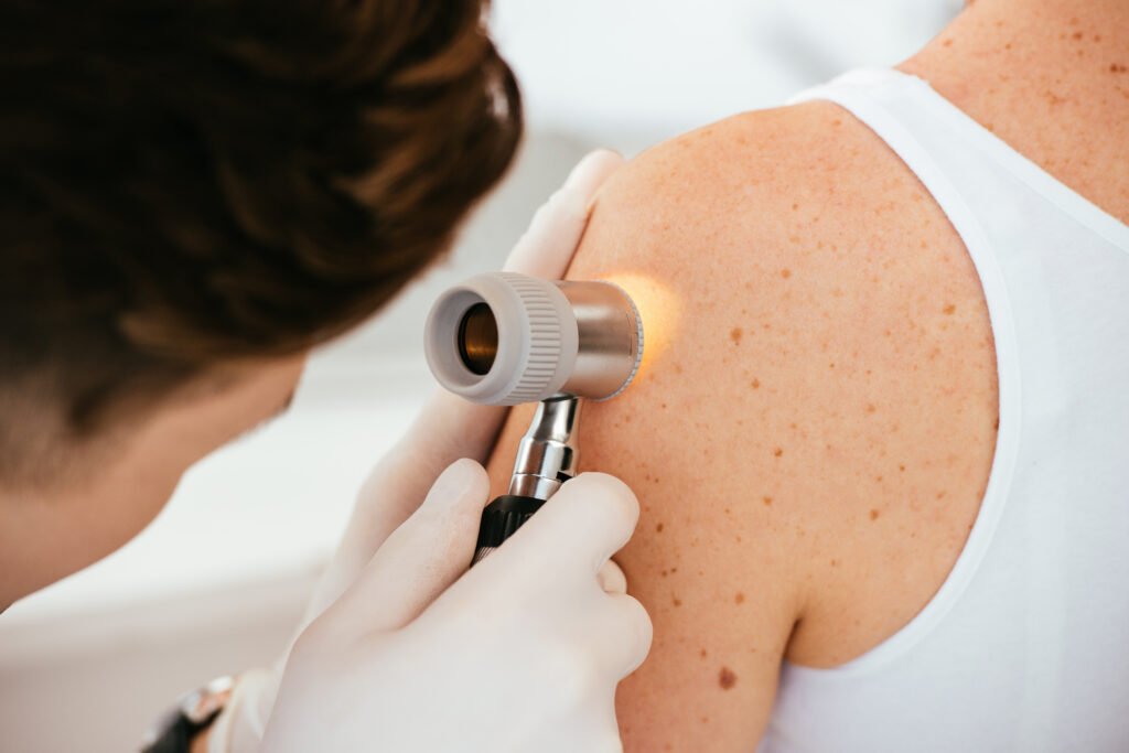 melanoma