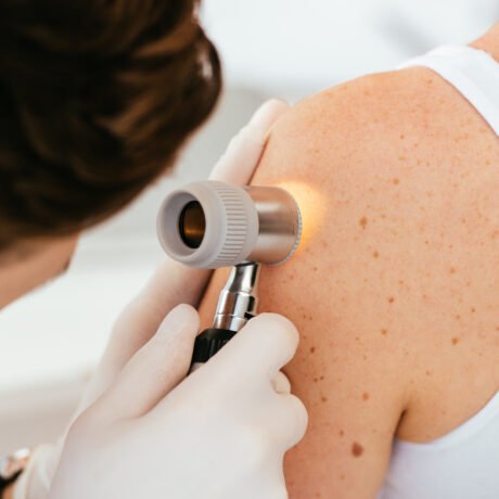 melanoma