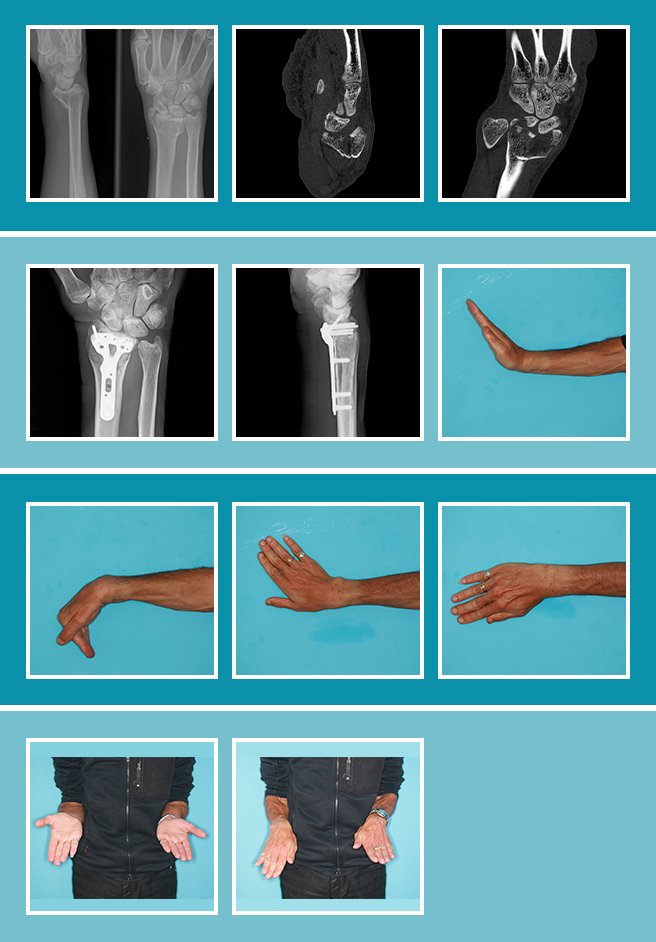 3.-Fractura-muñeca_CASO_3.1