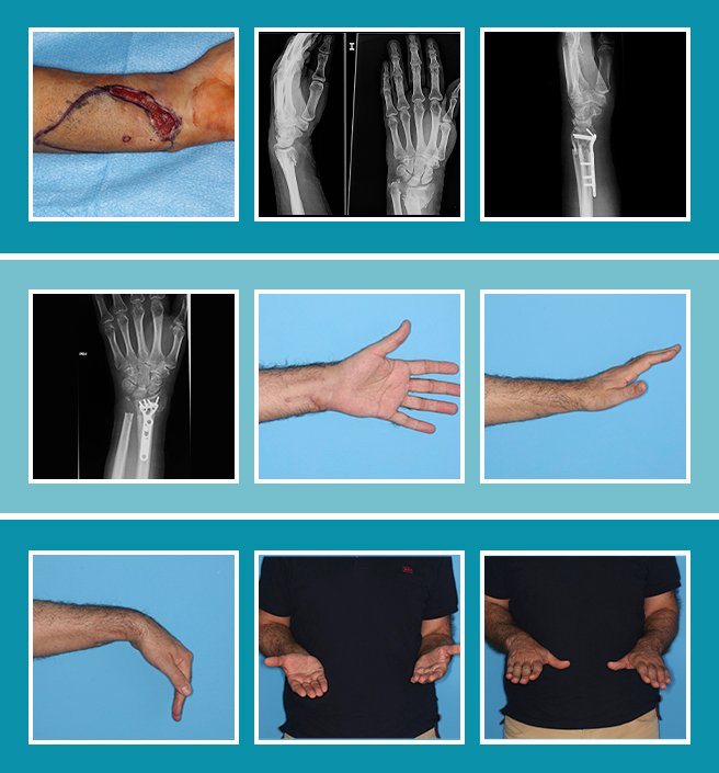 3.-Fractura-muñeca_CASO_3.2