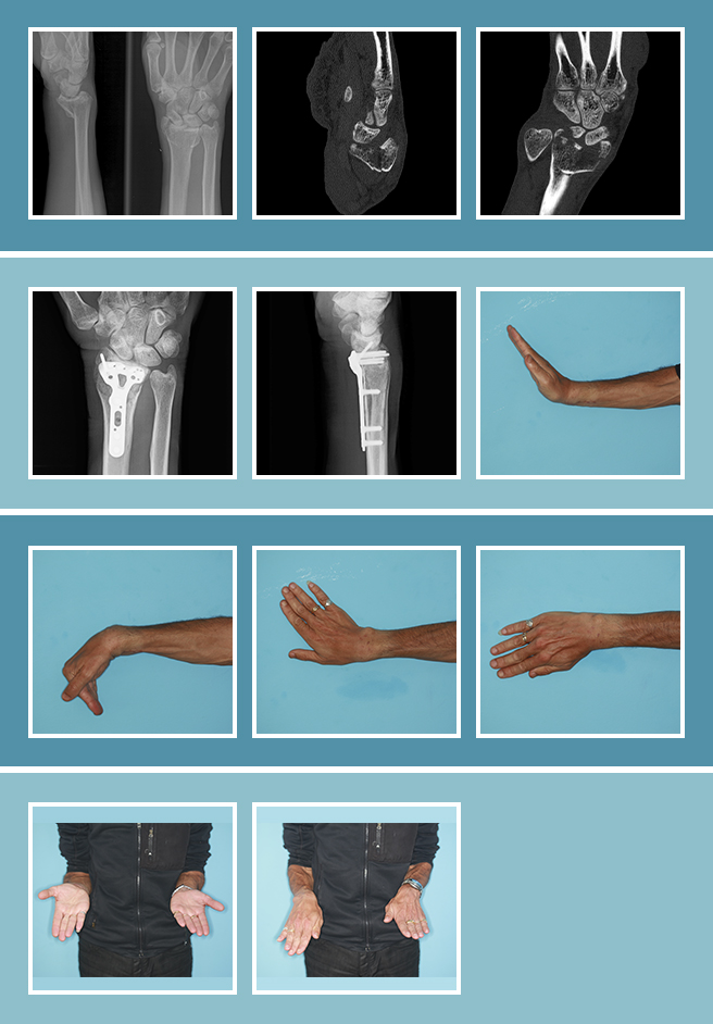 3.-Fractura-muñeca_CASO_3.1