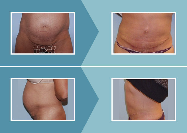 Lifting Abdominal: Abdominoplastia