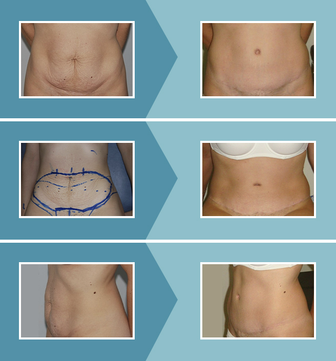 Abdominoplastia_caso2