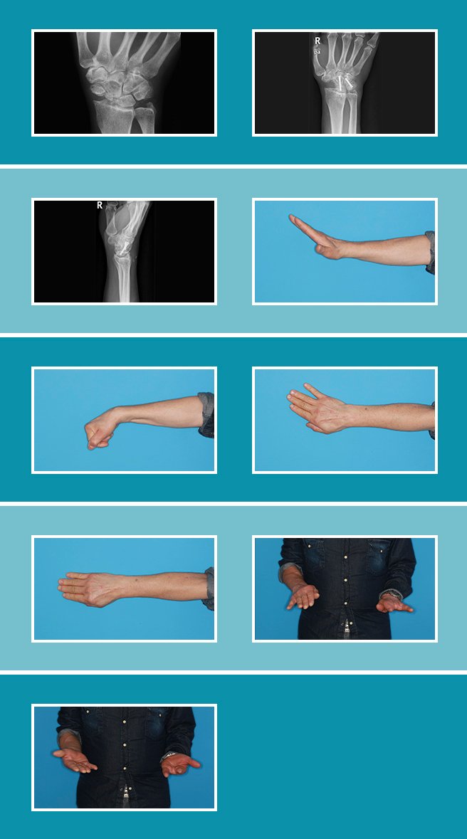 Artrosis-de-la-muñeca_8.1 Artrosis-de-la-muñeca_8.1