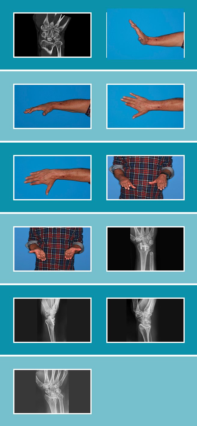 Artrosis-de-la-muñeca_8.2 Artrosis-de-la-muñeca_8.2