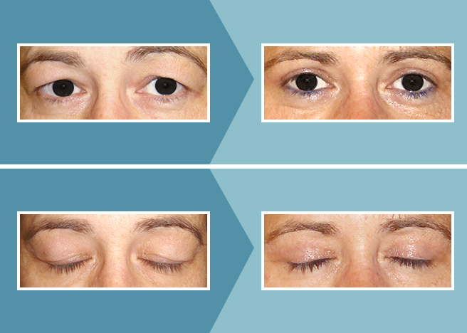 Blefaroplastia_Caso_01