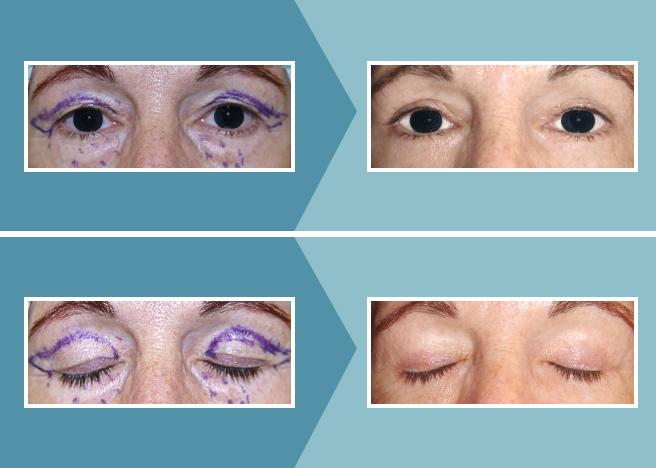 Blefaroplastia_Caso_02