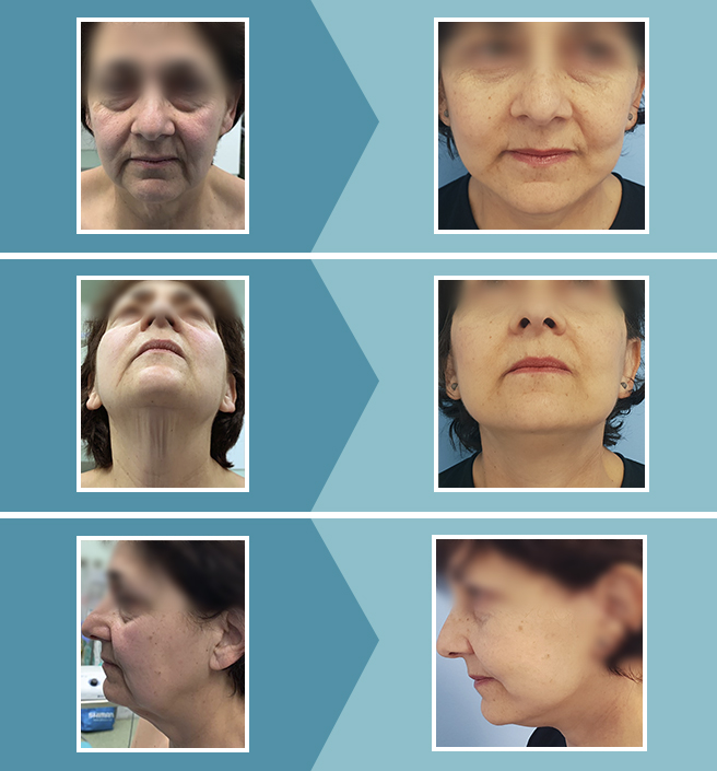 Qué tipos de lifting facial existen?