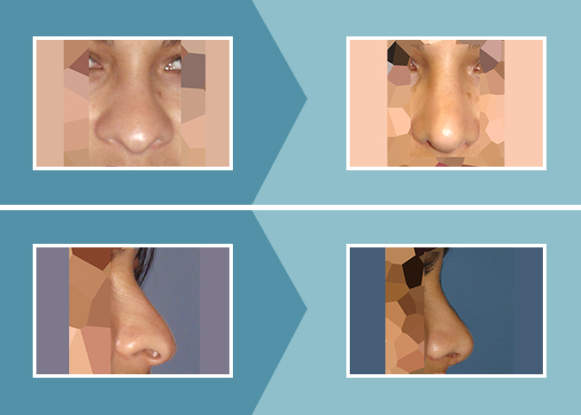 Rinoplastia_Caso_02