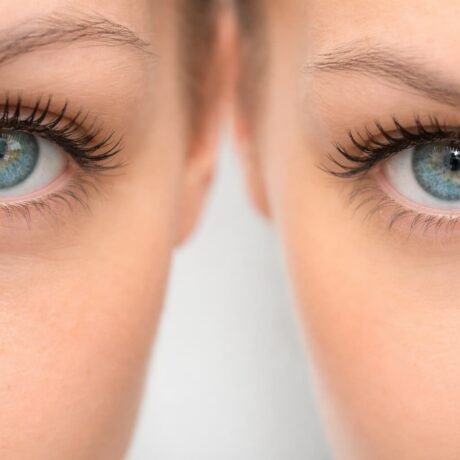 5 consejos para una mejor recuperación tras blefaroplastia