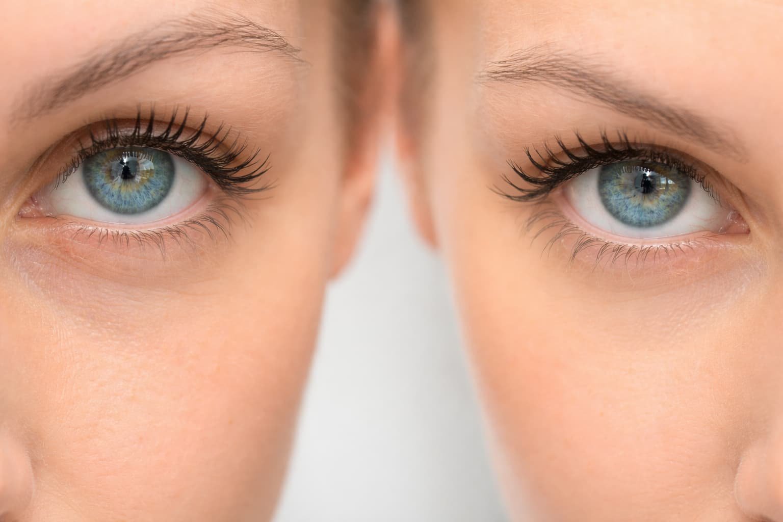 5 consejos para una mejor recuperación tras blefaroplastia