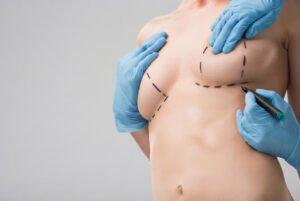 ¿En qué consiste la Mastopexia?