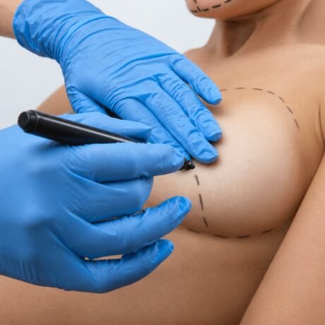 lipofilling mamario o aumento de pecho con grasa propia