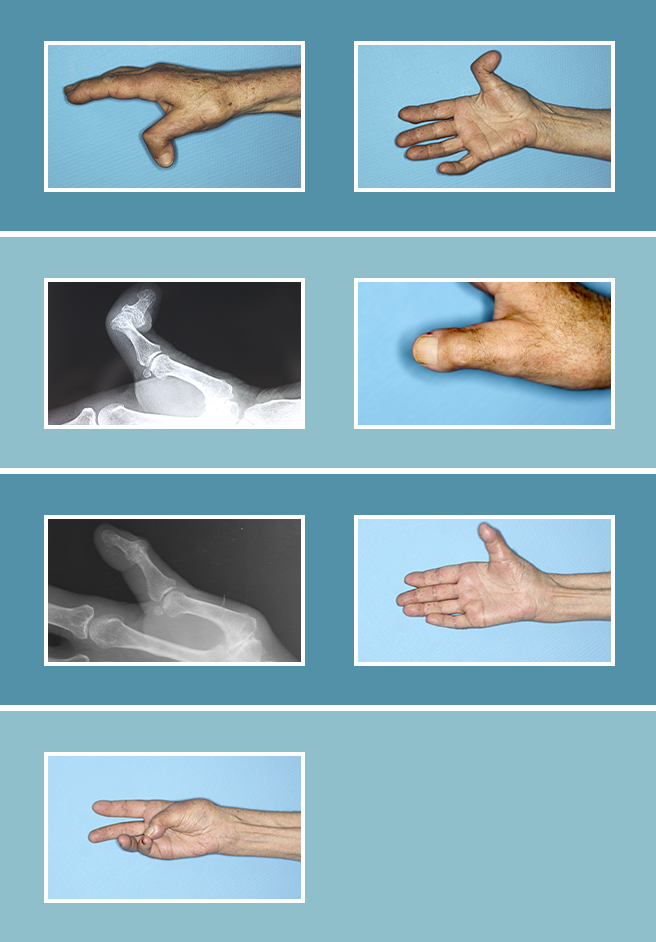 Montón de Acuerdo Asentar Artrosis de la Mano | Clínicas de Cirugía Estética