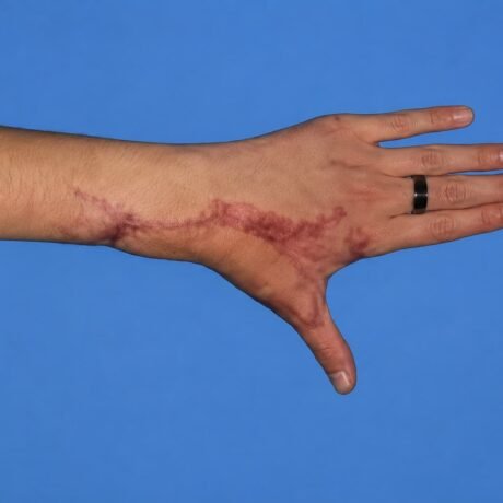 Cirugía reconstructiva de la mano