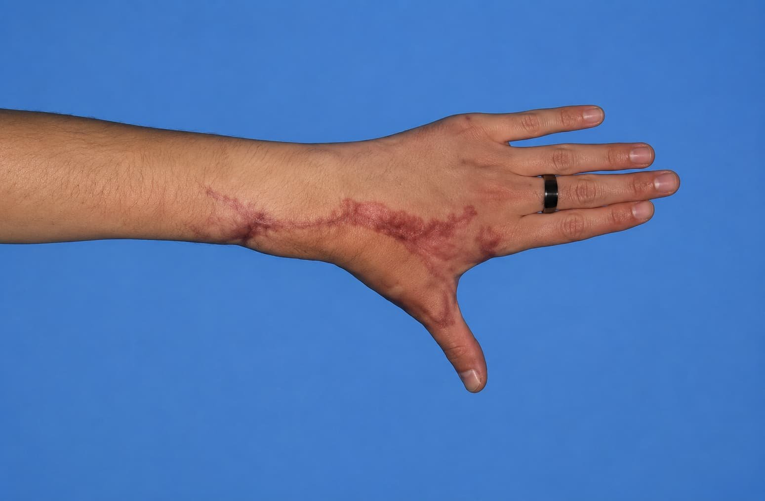 Cirugía reconstructiva de la mano