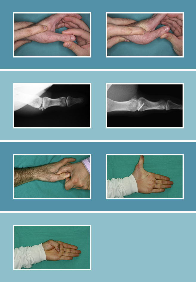 11.-Lesiones-ligamentosas_11.1