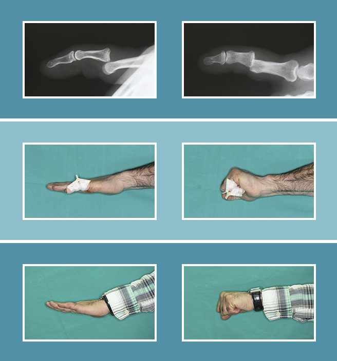 11.-Lesiones-ligamentosas_11.2