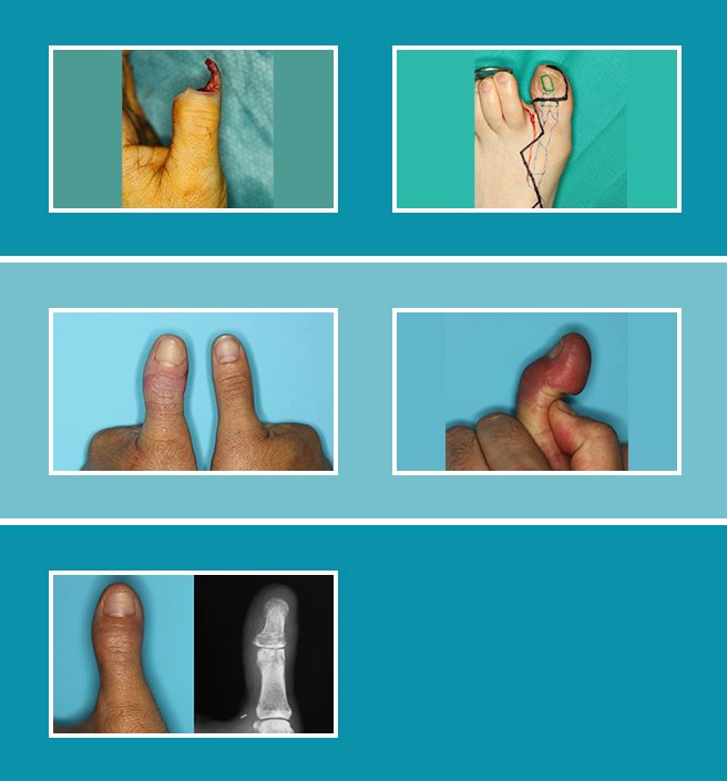 6.-Reconstruccción-pulgar_6.1 6.-Reconstruccción-pulgar_6.1