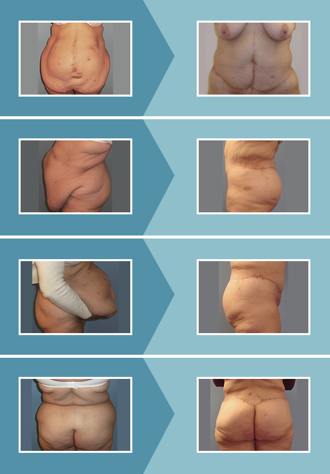 Manual de Cirugía plástica detallada - 1 Abdominoplastia Concepto