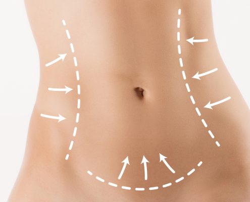 Body correction with the help of plastic surgery on white background