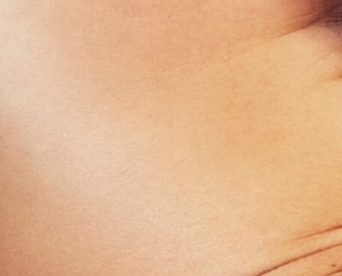 obesidad-cirugia-reconstructiva-clinica-estetica-valladolid