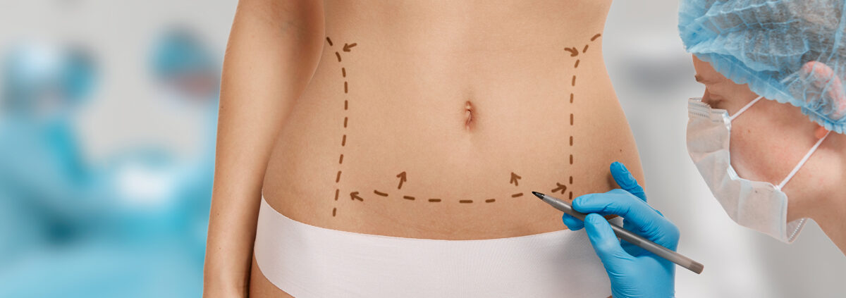 liposuccion laser