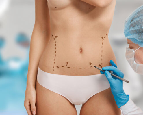 liposuccion laser