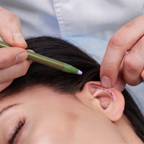 cirugia de las orejas, otoplastia
