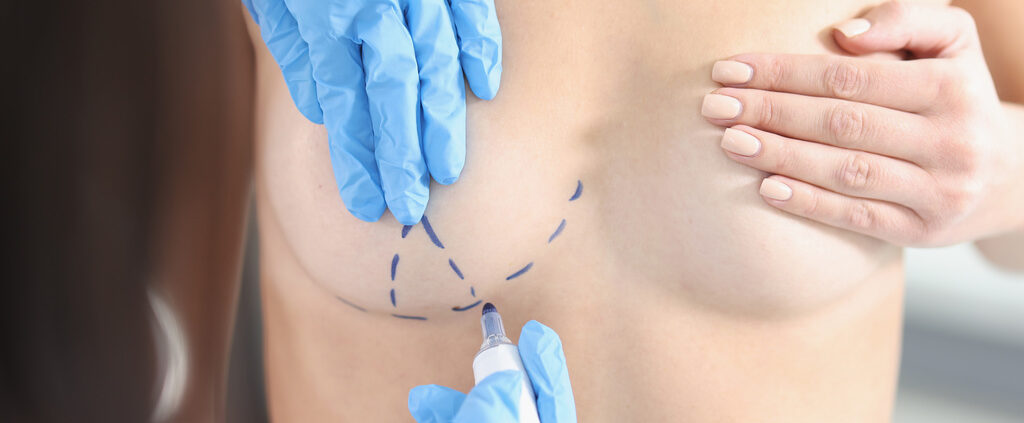 ☐ Mastopexia sin implantes: ¿Cómo reposicionar el pecho sin prótesis?