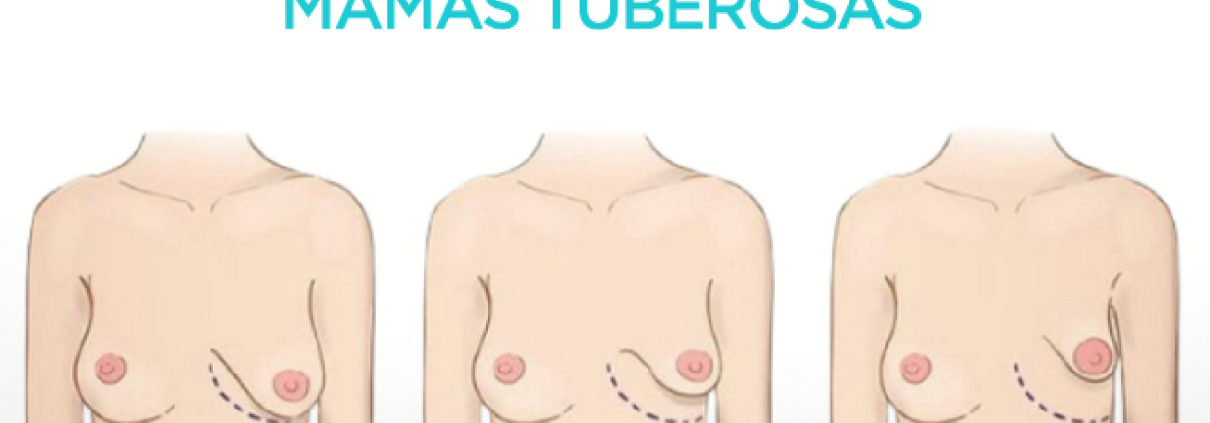 mamas tuberosas