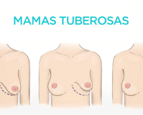 mamas tuberosas