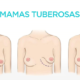 mamas tuberosas