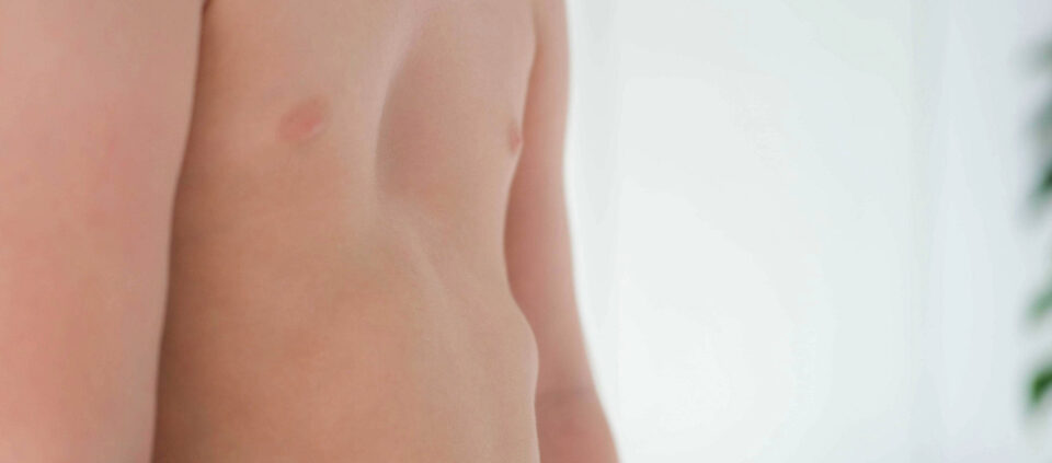 pectus excavatum