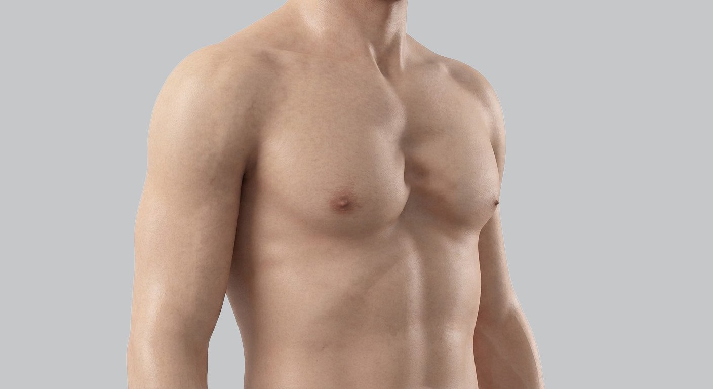 pectus excavatum chico