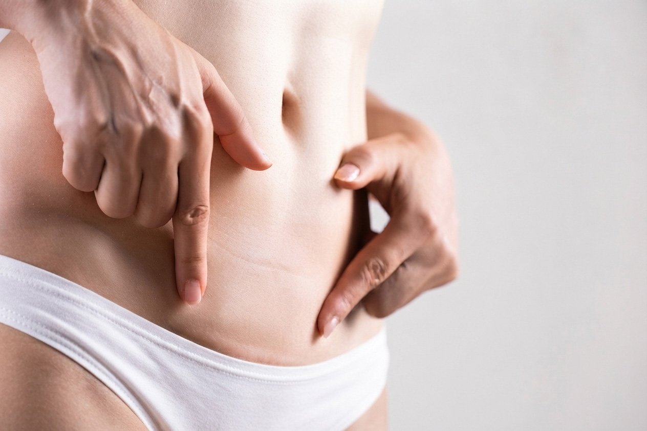 cicatriz_cirugia_abdomen