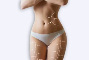 Las claves para la buena recuperación de una liposucción