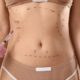 abdominoplastia