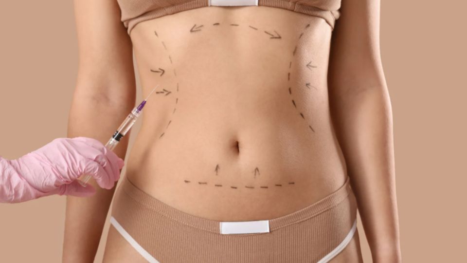 abdominoplastia
