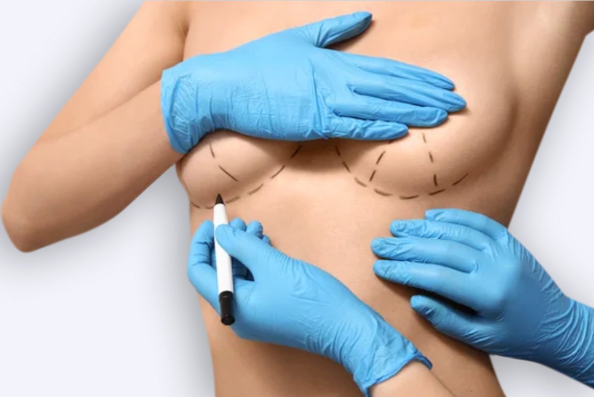 aumento-mamario-doctor-sanz-santander-valladolid