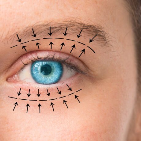 blefaroplastia completa