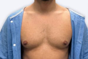 Ginecomastia: qué es, causas y soluciones para la cirugía de reducción de pecho para hombre 