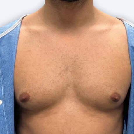 ginecomastia-hombre-cirugia