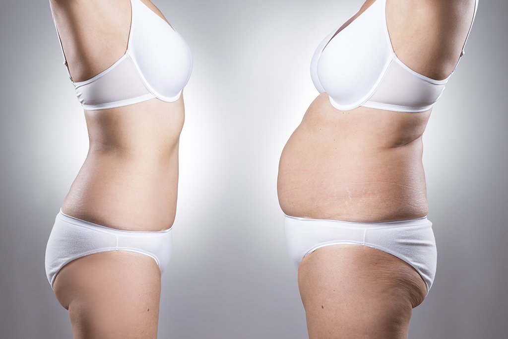 En qué consiste la liposucción o lipoescultura y qué resultados tiene?