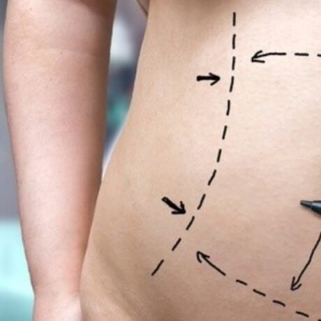 Qué cirugía se aplica tras sufrir obesidad mórbida