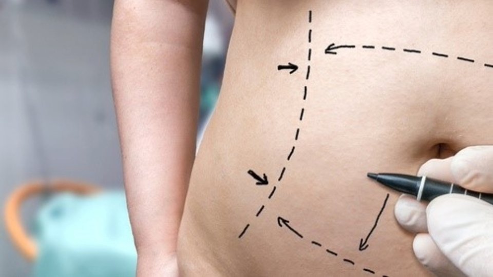 Qué cirugía se aplica tras sufrir obesidad mórbida