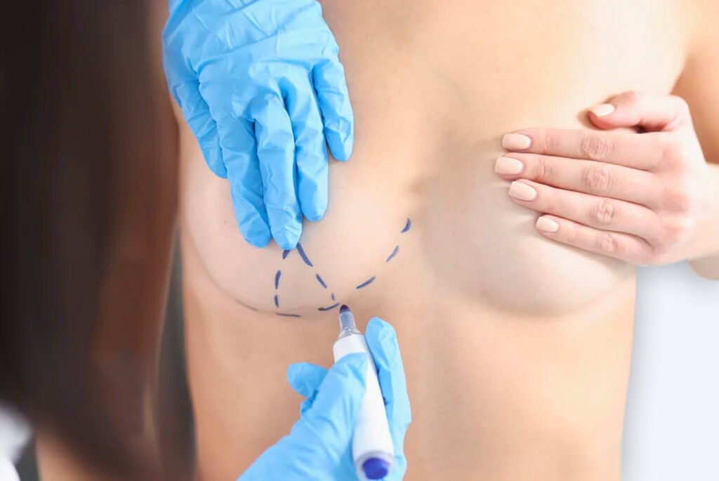 mastopexia-sin-implantes